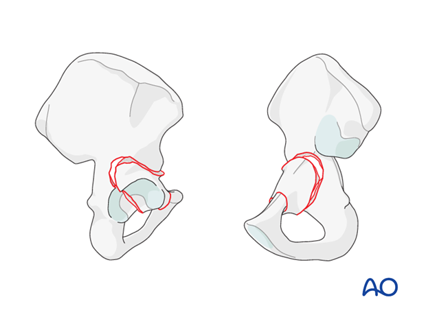 characteristics of elemental fracture types