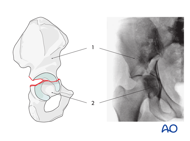 characteristics of elemental fracture types