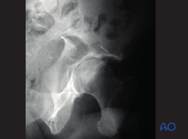 characteristics of elemental fracture types