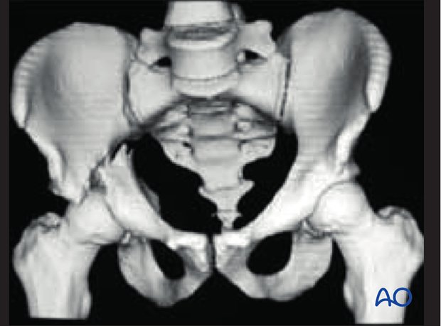 characteristics of elemental fracture types