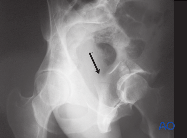 characteristics of associated fracture types