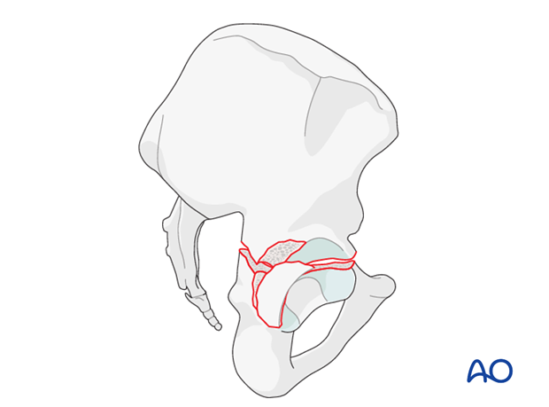 characteristics of associated fracture types