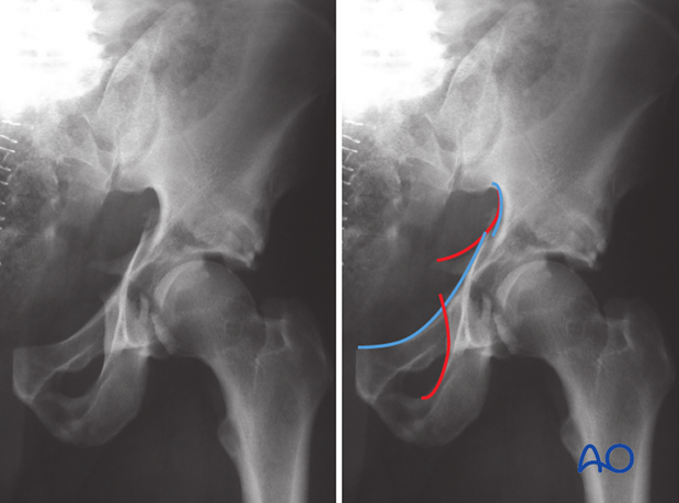 characteristics of associated fracture types