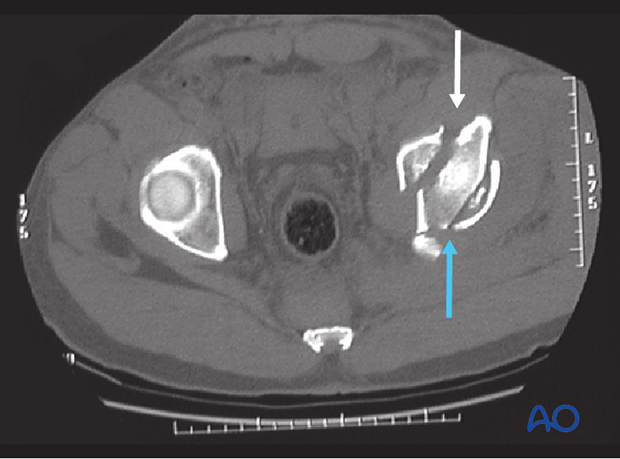 characteristics of associated fracture types