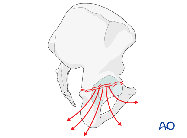 characteristics of associated fracture types