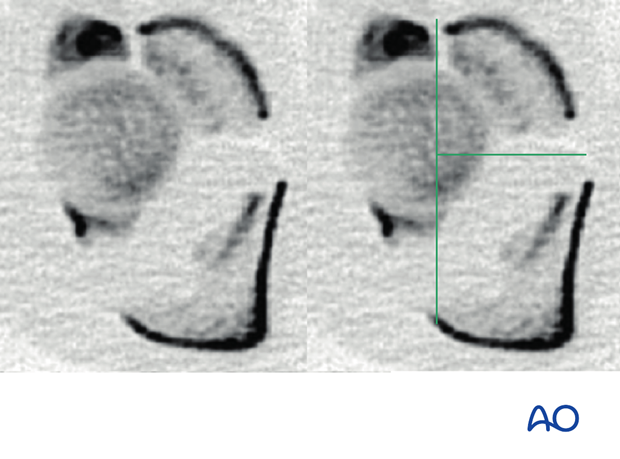 characteristics of associated fracture types