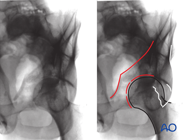 characteristics of associated fracture types