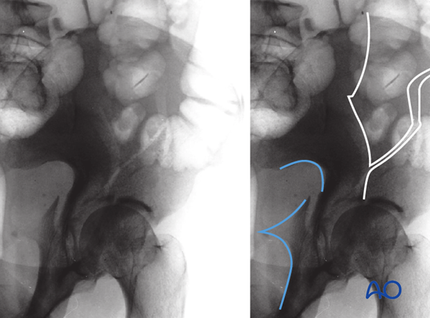 characteristics of associated fracture types