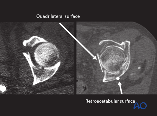 characteristics of associated fracture types