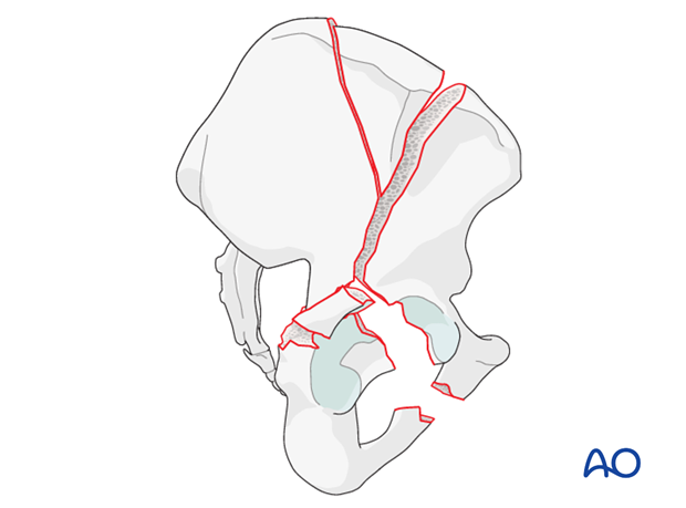 characteristics of associated fracture types