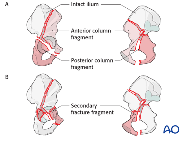 characteristics of associated fracture types