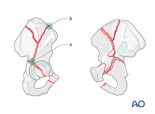 characteristics of associated fracture types