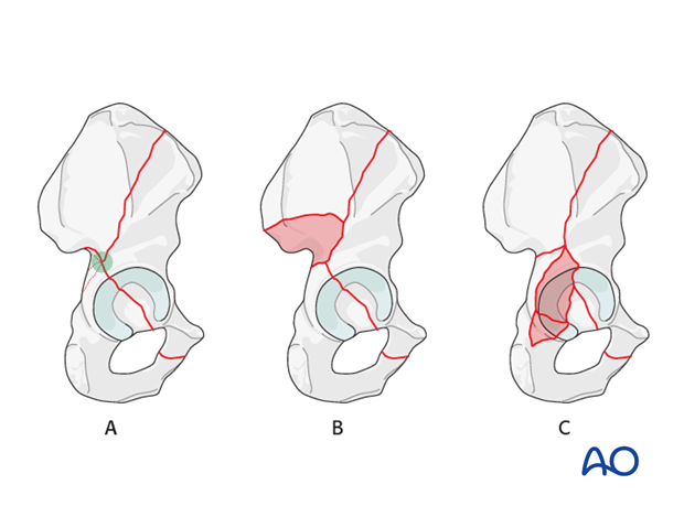 characteristics of associated fracture types