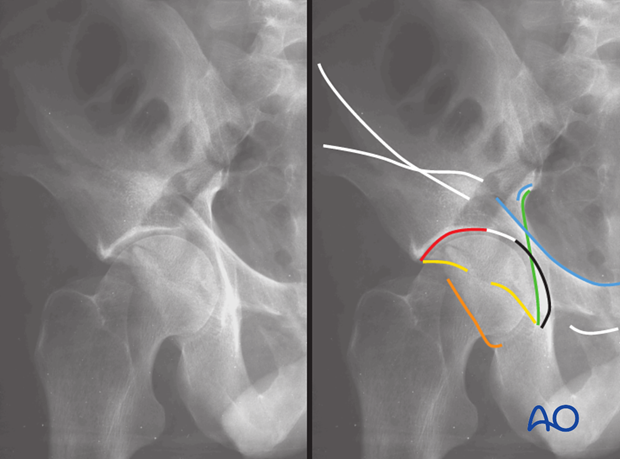 characteristics of associated fracture types