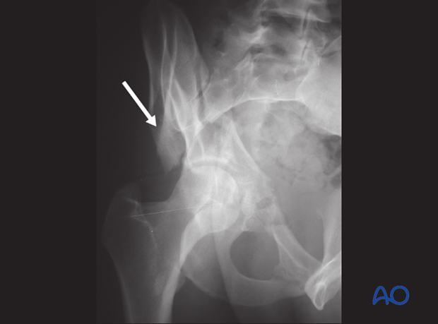 radiology of the intact acetabulum