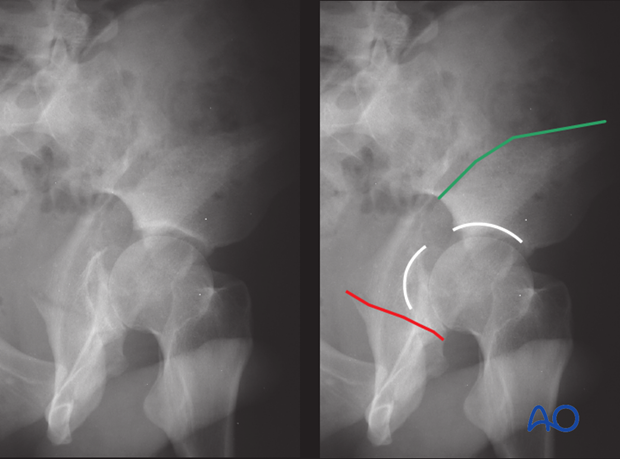 characteristics of associated fracture types