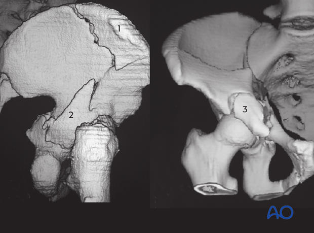 characteristics of associated fracture types