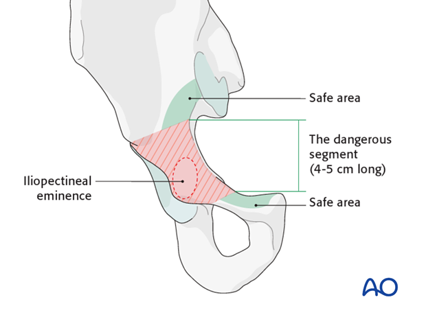 general stabilization principles and screw directions