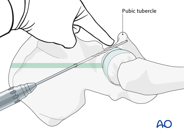 general stabilization principles and screw directions