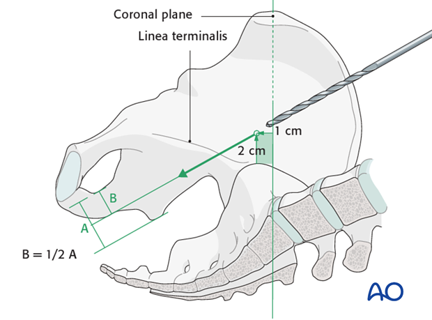 general stabilization principles and screw directions