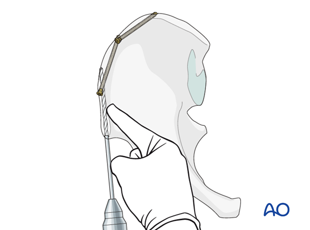 general stabilization principles and screw directions