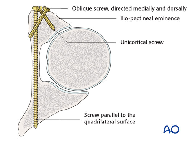 general stabilization principles and screw directions