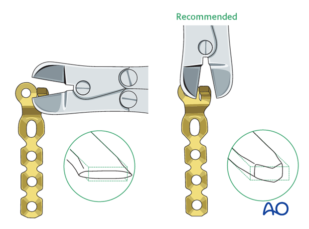 minicondylar plate fixation