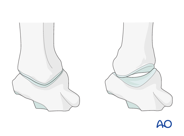 The joint surfaces of the trapezium and thumb metacarpal resemble two reciprocally interlocking saddles. This articular ...