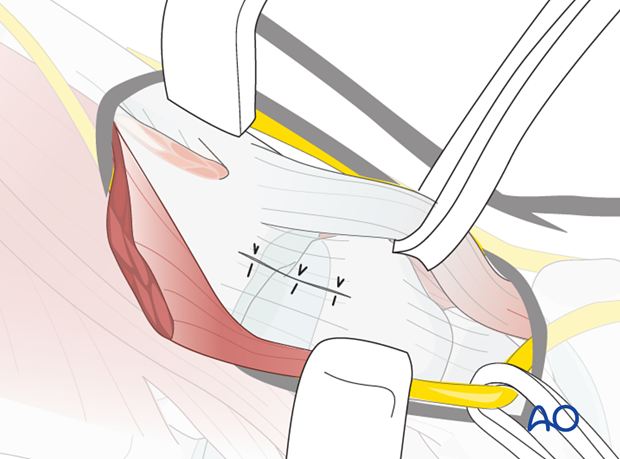 Close the capsule with interrupted sutures. Reattach the thenar muscles to the base of the first metacarpal using ...