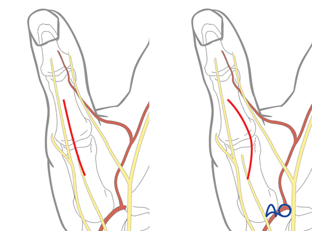 This approach is indicated for intraarticular, or periarticular, fractures of the metacarpophalangeal (MCP) joint of the thumb.