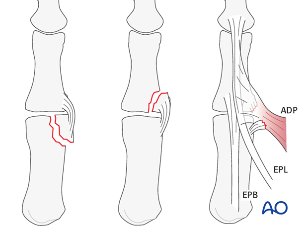 This approach is indicated for intraarticular fractures in the ulnar margin of the head of the first metacarpal avulsion ...