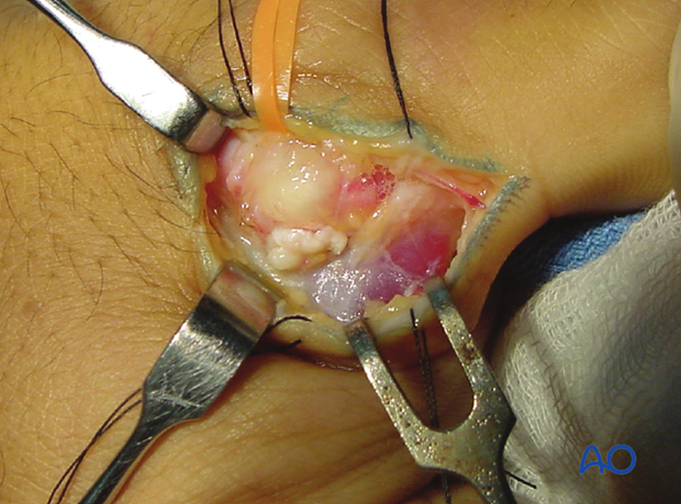 Identify the adductor pollicis muscle with its aponeurosis, as well as the tendons of EPL and EPB.