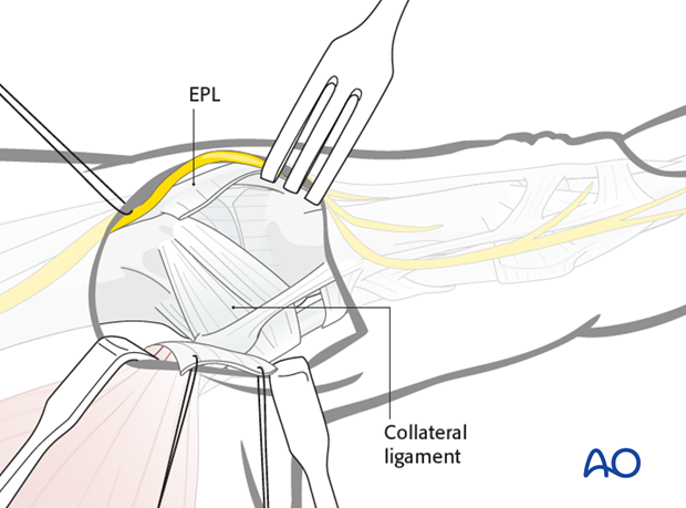 Retract the aponeurosis in a palmar direction using fine sutures, ...