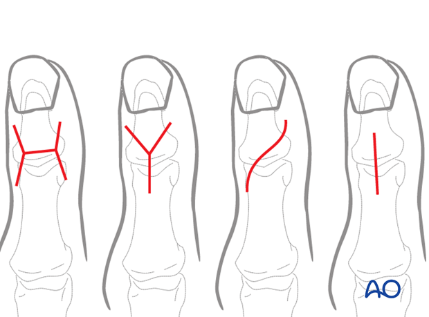 This approach is indicated for intraarticular fractures, arthrodesis and avulsion fractures.