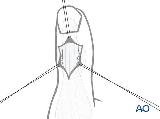 Depending on the shape of the skin incision, flaps should be elevated and held with fine sutures to minimize soft-tissue trauma.