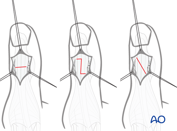 Divide the distal tendon of the EPL using either a transverse tenotomy, a step cut, or a long oblique cut. The step cut and ...