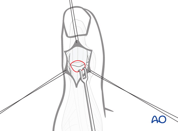 Retract the EPL tendon proximally in order to expose the interphalangeal joint.