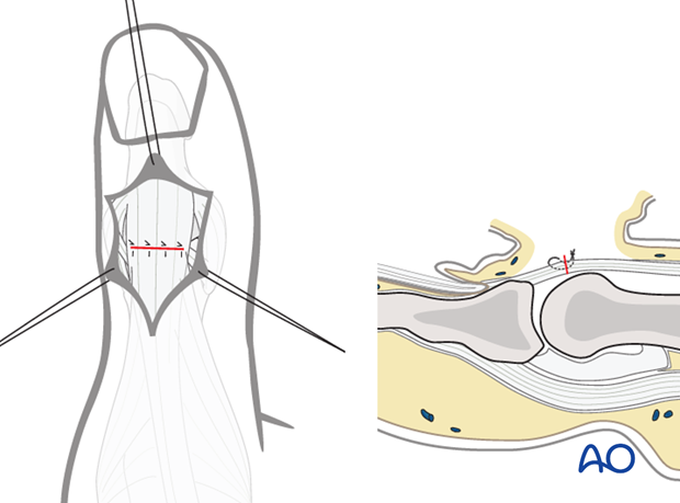 Repair the tenotomy using fine interrupted mattress sutures.