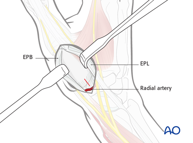 In the case of intraarticular fractures, or arthrodesis, a capsulotomy of the first carpo-metacarpal joint is made.