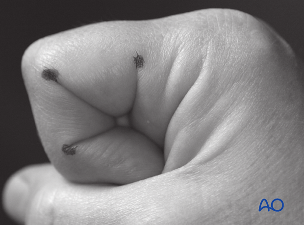 For planning the plane of the incision, fully flex the finger as shown and mark the ends of the joint skin creases with dots.