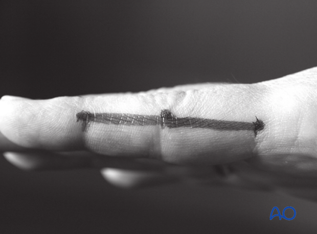 Extend the finger and connect the dots in a line. The resulting line is safe for a skin incision. The digital artery and ...