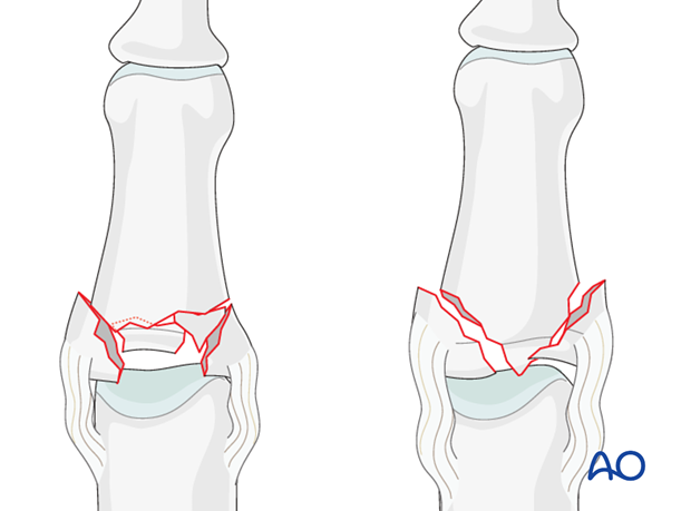 These fractures are very unstable. 