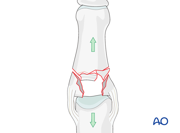 Compression fractures are not reducible by ligamentotaxis, as the centrally impacted fragments are devoid of soft-tissue ...