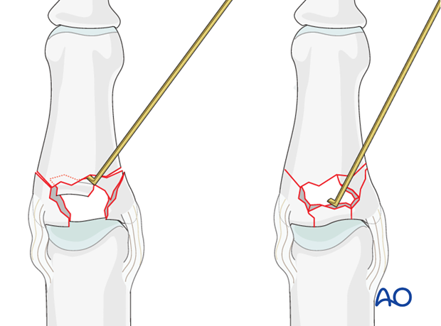 Using a K-wire, or dental pick, the fragments are disimpacted and pushed towards the head of the metacarpal, which is used ...