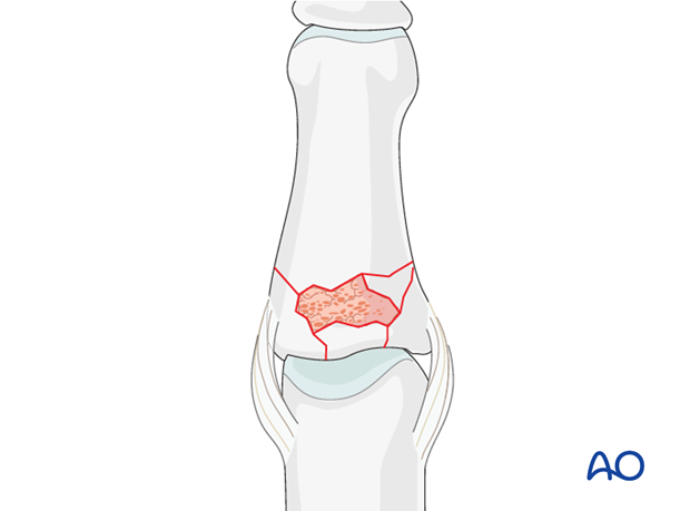 Cancellous autograft will be necessary to support the articular fragments and fill the impaction void. The graft will also ...