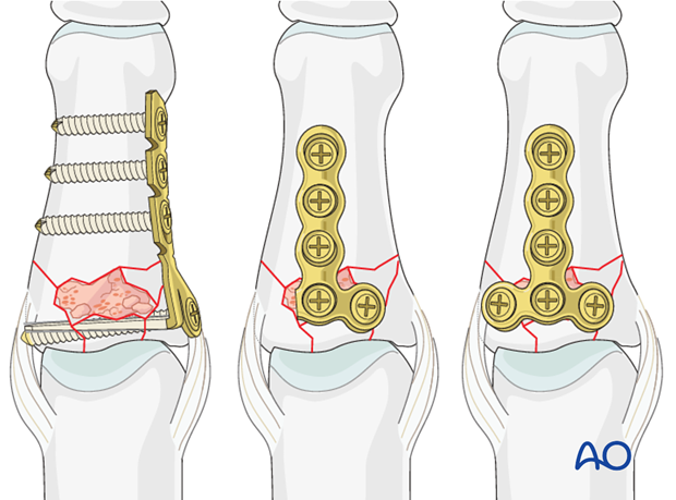 minicondylar plate fixation of pilon compression fracture