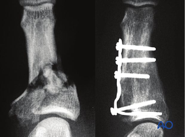 minicondylar plate fixation of pilon compression fracture