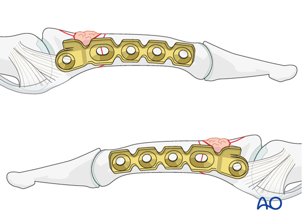 minicondylar plate fixation of pilon compression fracture