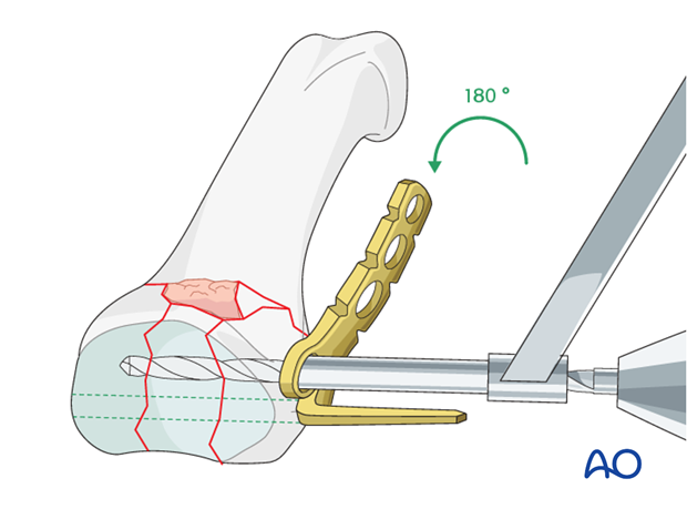 minicondylar plate fixation of pilon compression fracture