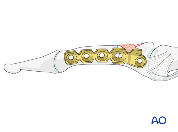 minicondylar plate fixation of pilon compression fracture